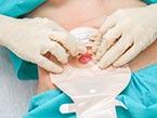 Ostomy Care: Colostomy, Ileostomy, Urostomy from Wild Iris Medical Education